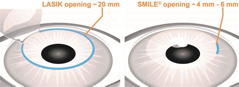 Laser Vision Correction Surgery in Dallas | LaserCare Eye Center