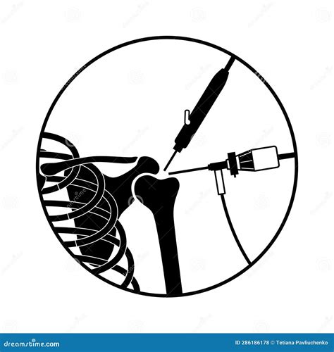 Shoulder Arthroscopy Poster Stock Vector Illustration Of Laparoscopy Surgery 286186178