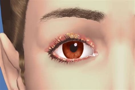 Management Of Eyelid Conditions