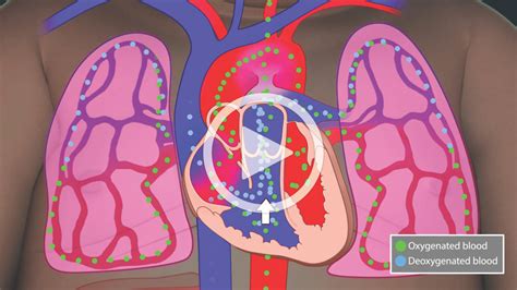 Patent Ductus Arteriosus Animation