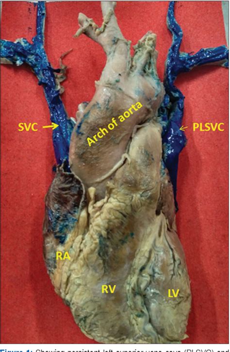 Figure From Persistent Left Superior Vena Cava And Its Clinical