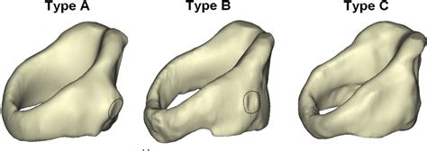 Figure 4 from The role of the cricothyroid joint anatomy in ...