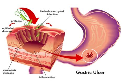 Lecture Helicobacter Pylori And Gastritis Gastrointestinal