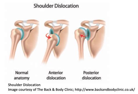 Emergency Medicine Educationem3am Posterior Shoulder