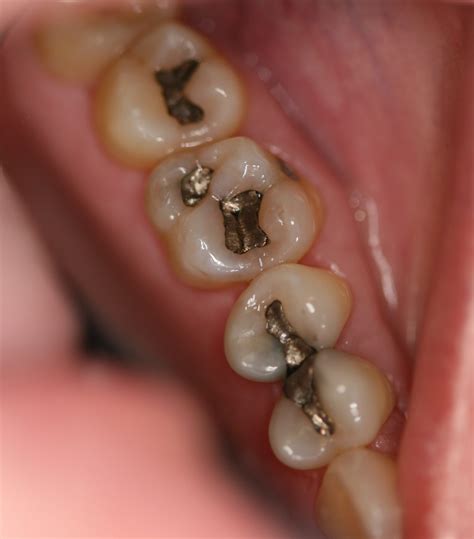 Composite Resin Fillings | Nadim J Jubran DDS PC