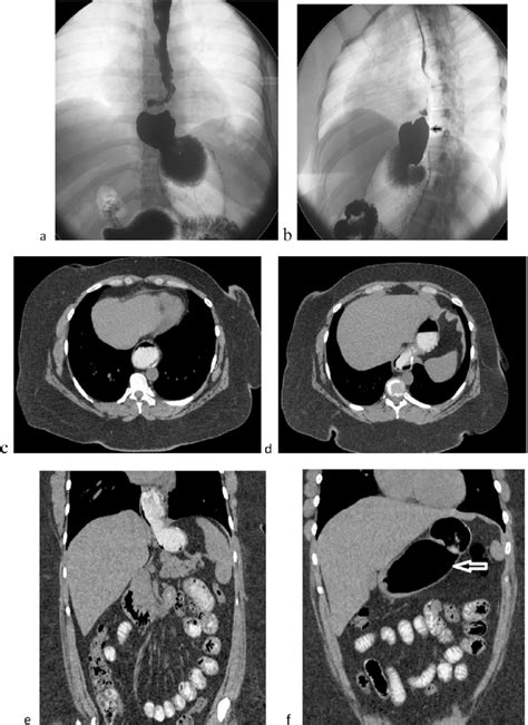 A Forty Year Old Female Patient With Bmi Of 56 Kgm 2 Weighted 165 Kg