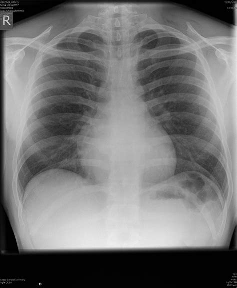 Pneumomediastinum - PMC