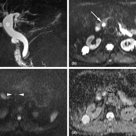 A Representative Mri Image Of A Patient With A Type I Choledochal Cyst Download Scientific