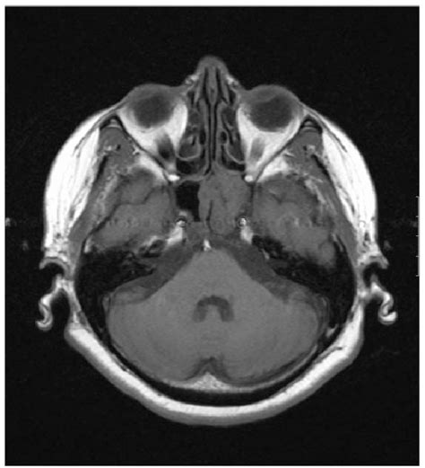 Figure 3 From Isolated Sphenoid Fungal Sinusitis And Coexisting Intrasellar Mass Lesion