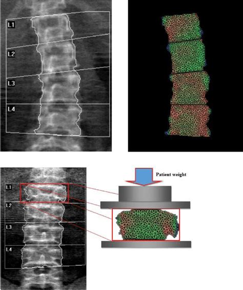 Example Of A Lumbar Dual Energy X Ray Absorptiometry Dxa Scan In The