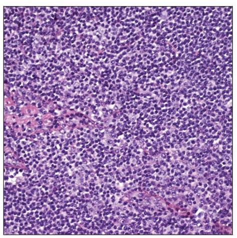 Extranodal Marginal Zone B Cell Lymphoma Malt Lymphoma Basicmedical Key