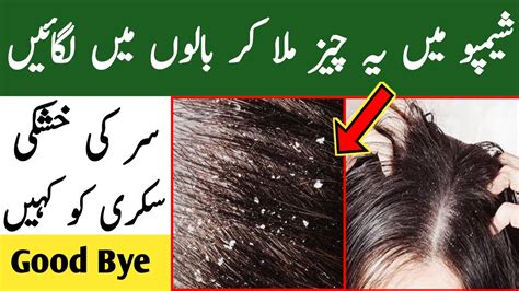 How To Get Rid Of Dandruff Solution At Home Dandruff Ka Ilaaj Balon