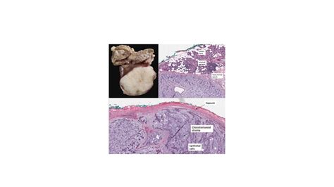 Pathology of Pleomorphic Adenoma - Pathology Made Simple