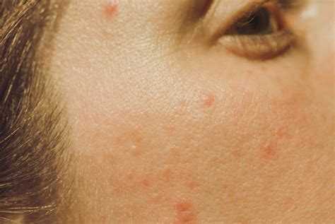 A Dermatologist Approved Guide To Acne Clearing Laser Treatments