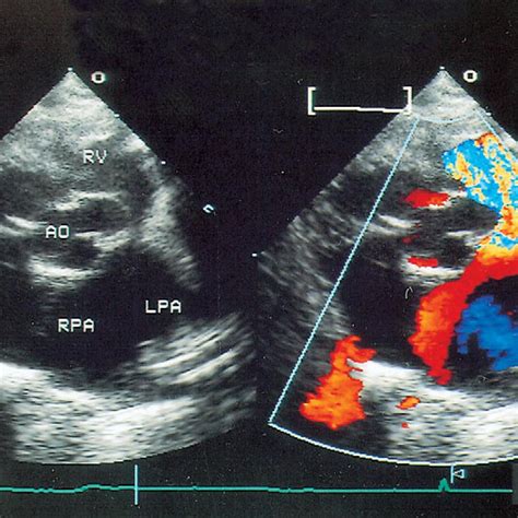 Preoperative Echocardiography Parasternal Short Axial View Shows A