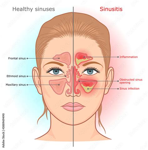 Sinusitis infection and normal sinuses medical diagram. Stock Vector | Adobe Stock