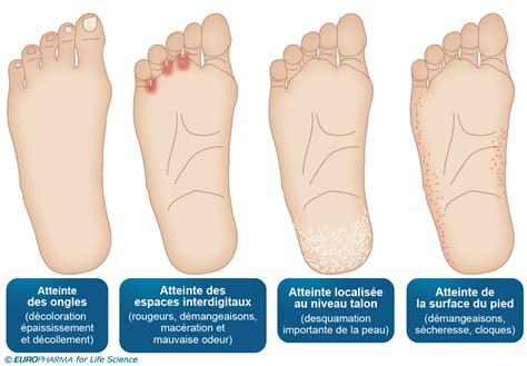 Mycose Des Pieds Sympt Mes Diagnostic Traitement