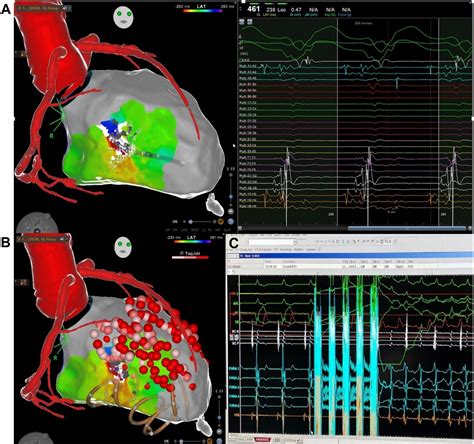 Pulsed Field Ablation Vs Radiofrequency Ablation For Ventricular