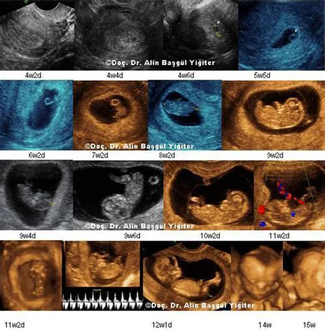 7 Haftalık Erkek Bebeğin Ultrason Görüntüleri Olağanüstü Bebek Rehberi