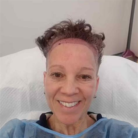 How To Fix A Pushed Back Hairline Permanently Ksl Clinic
