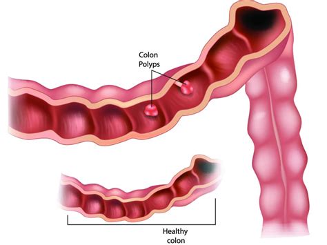 Colon Polyps Causes Treatments Colon Doctor Atlanta