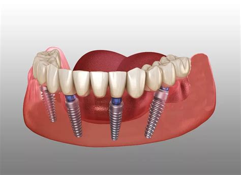 All On 4 Dental Implants In Turkey All On Four Implants In Antalya