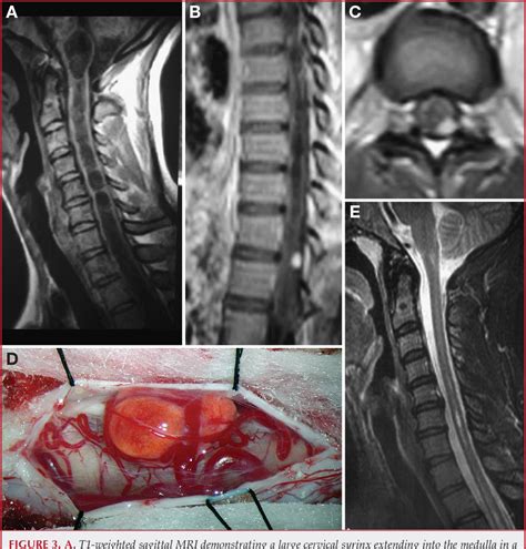 Figure 3 From OPERATIVE MANAGEMENT OF SPINAL HEMANGIOBLASTOMA