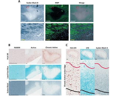 Classification Of Ms Lesions Based On Histochemical And Download