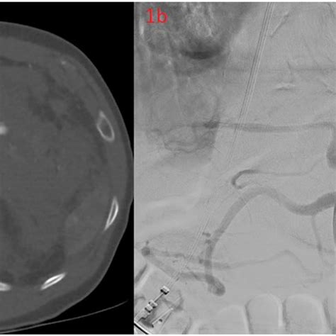 A Computed Tomography Angiogram Demonstrating Splenic Artery