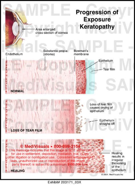 Medivisuals Progression of Exposure Keratopathy Medical Illustration