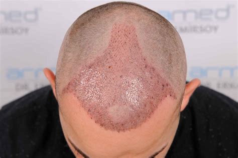 Haarwachstum Nach Haartransplantation Verlauf Und Regeln