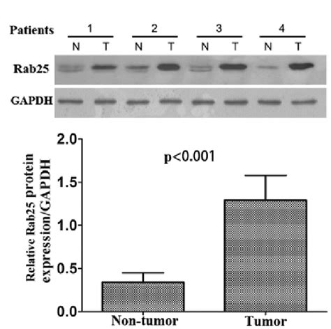 Increased Rab25 Protein Expression In CcRCC A Representative Western