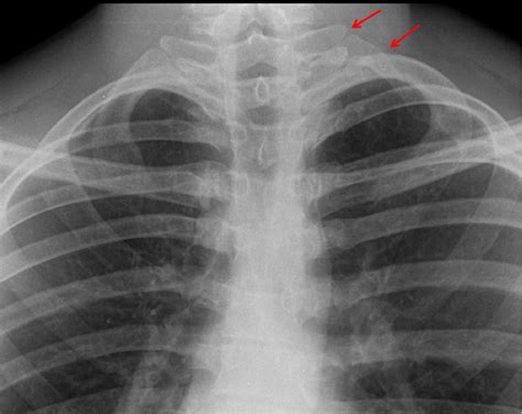 Radiology Of Ribs Spectrum Of Normal Variants And Pathological