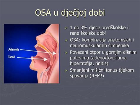 PPT OPSTRUKTIVNA APNEJA U SNU U DJEČJOJ DOBI PowerPoint Presentation