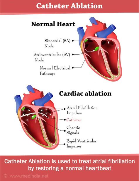 Atrial Fibrillation Causes Symptoms Diagnosis Treatment Complication Risks