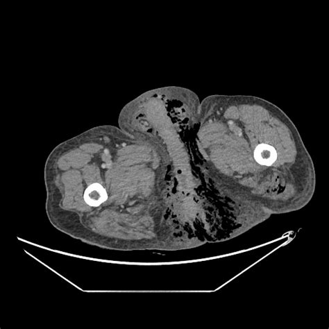 Fournier Gangrene Image Radiopaedia Org