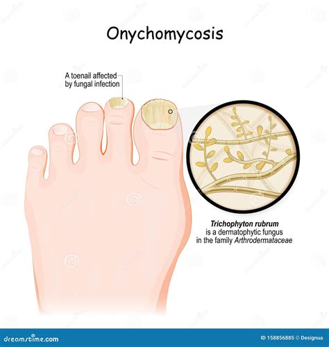 Fungal Infection Face Pictures Molluscum Contagiosum Causes Symptoms