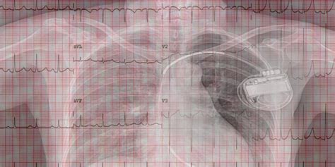 Muerte súbita cardiaca Síntomas tratamiento y prevención