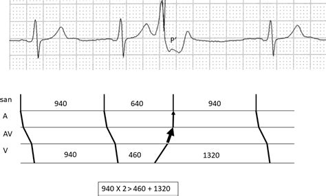 Ectopic Beats Cardiac Electrophysiology Clinics