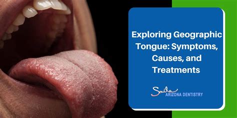 Exploring Geographic Tongue Symptoms Causes And Treatments