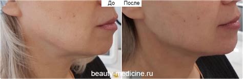 Векторный лифтинг Радиесс - Клиника косметологии Code Beauty Medicine