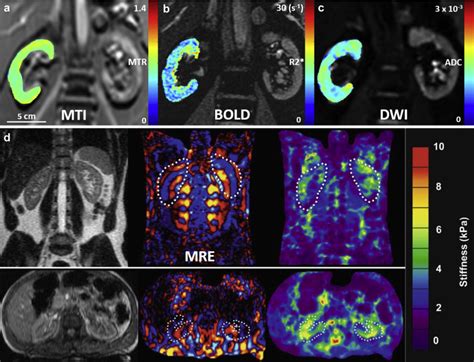 Basic Principles And New Advances In Kidney Imaging Kidney International