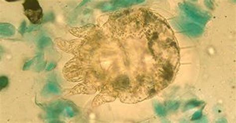 More than 300 inmates treated as scabies-like rash spreads through