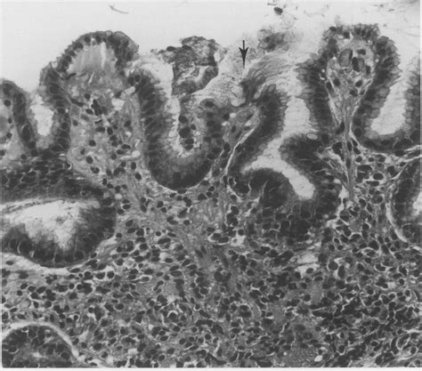 H Pylori Associated Chronic Gastritis Of The Antrum Showing Severe