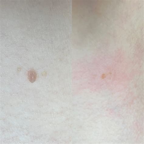 Laser Skin Tag Removal Laser Mole Removal Treatments Norwich