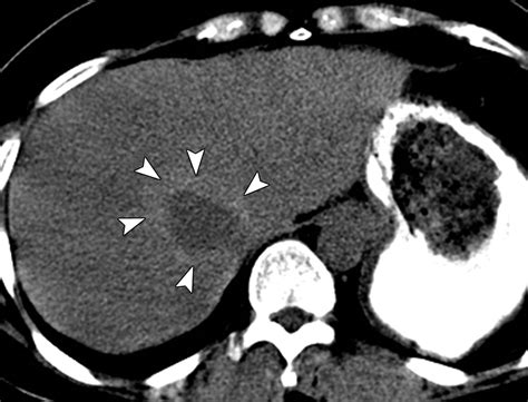 Sparing Of Fatty Infiltration Around Focal Hepatic Lesions In Patients