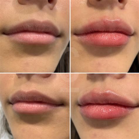 Understanding Lip Filler Migration Cosmetic Connection