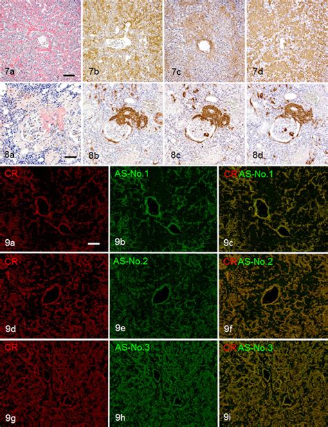 Amyloid A Aa Amyloidosis Liver Cat No 5 Aa Deposited Mainly In