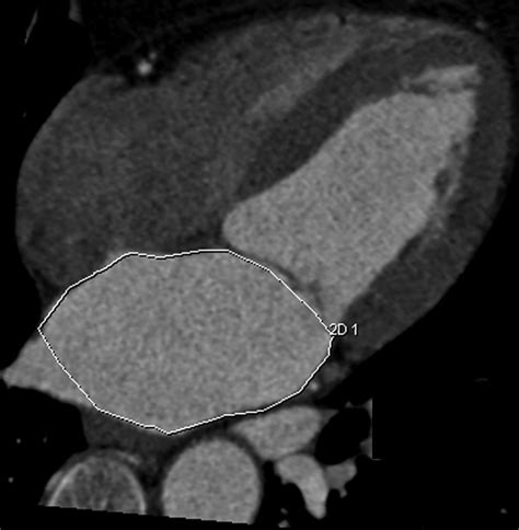 Sex Specific Normalized Reference Values Of Heart And Great Vessel