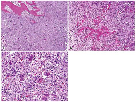 Histologic Findings In Central Giant Cell Granuloma A Cellular Tumor